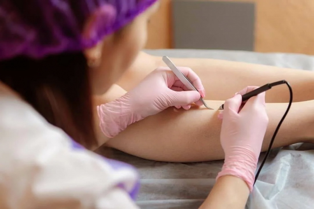 Блог - Електроепіляція чи лазерна епіляція: що краще обрати?” ключі: електроепіляція, лазерна епіляція, Candela, Lumenis, лазерна епіляція відгуки